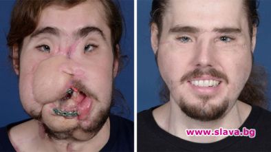 26 годишен мъж преживя уникална трансплантация на лице и вече може