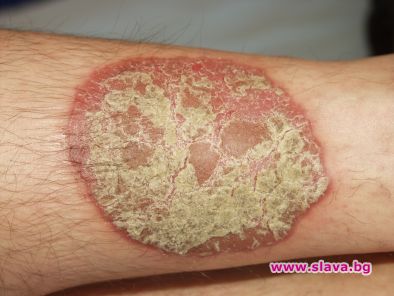 Псориазисът води до диабет