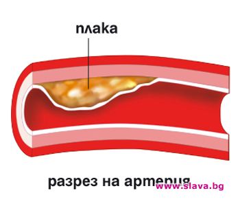 СВАЛЯТ ХОЛЕСТЕРОЛА БЕЗ ЛЕКАРСТВА