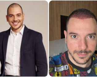 Цитиридис си присади коса